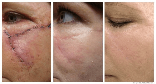 5 Things to Know About Scars 2 image