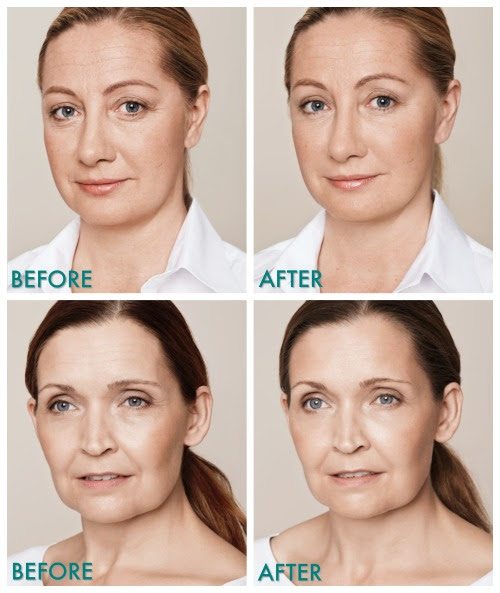 The Secret to Skin Restoration in 2016 2 befor after fillers