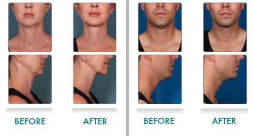 Benefit from Deoxycholic Acid Injectable 2 belkyra before after
