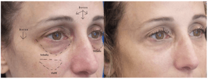 filler treatment brazen women article
