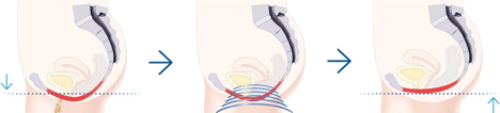The Emsella Kegel Chair Incontinence Treatment 1 emsella diagram toronto