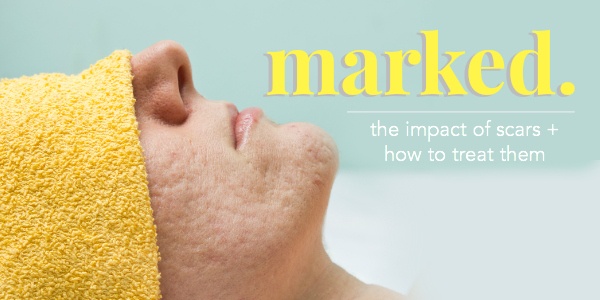 scar treatment toronto