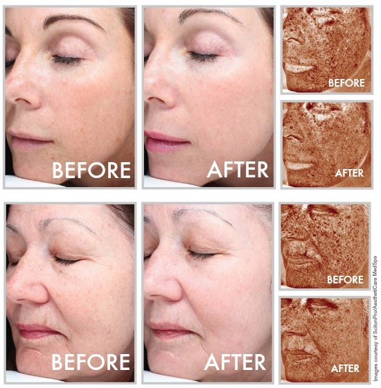 SPRING SPOTLIGHT: Hybrid Fractional Laser is here! 3 halo beforeafter