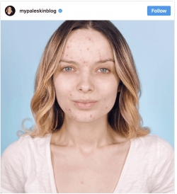 the acne awakening Toronto