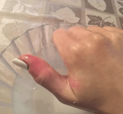 melanoma Toronto dermatology clinic