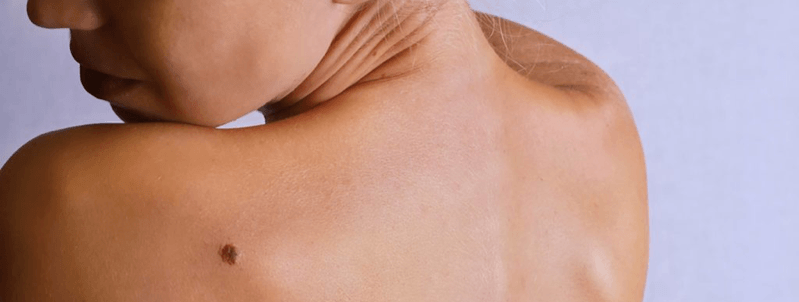 skin self exam