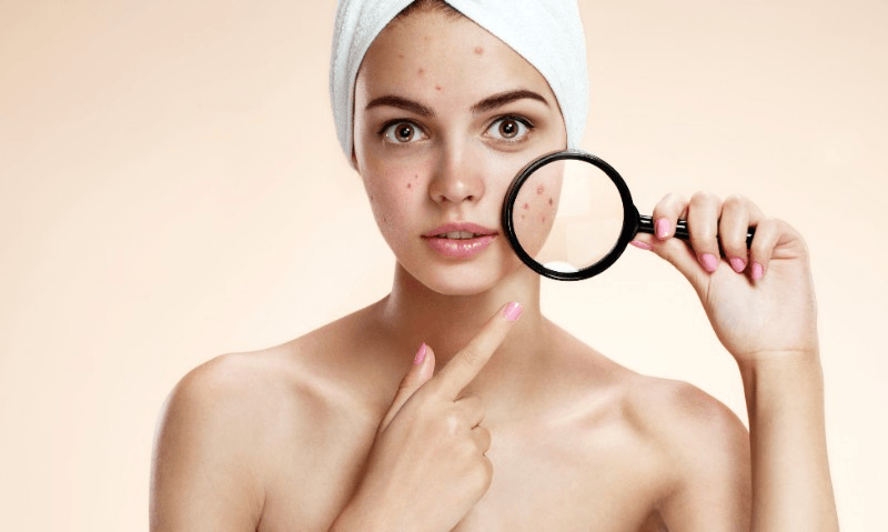 rosacea acne toronto