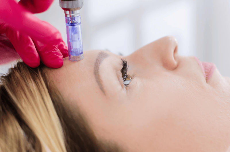 microneedling Toronto
