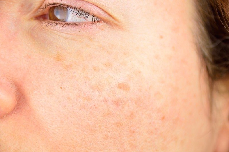 woman with acne scars