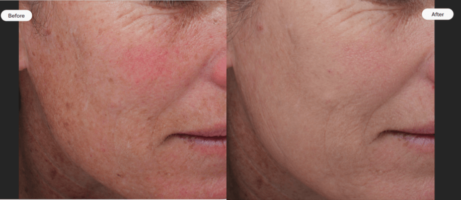 MOXI Laser 2 before and after moxi laser