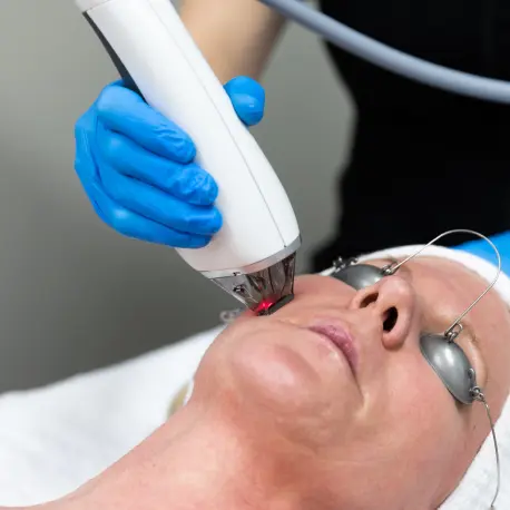 MOXI Laser 1 moxi laser toronto